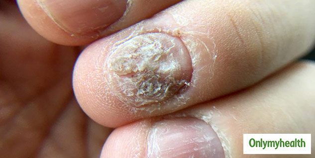 candida fungal infection nail