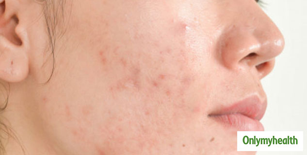 insidepimplesandacne