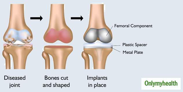 bone health