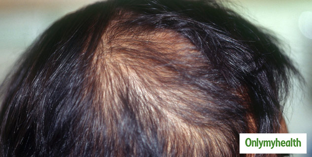 hair bald paches home remedies
