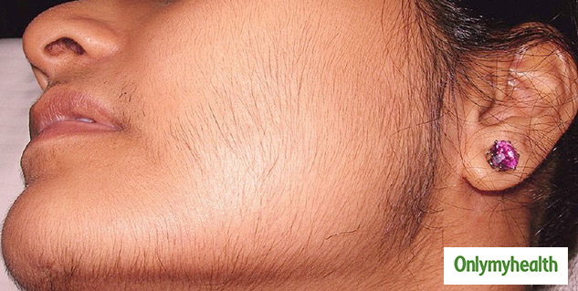 Facial hair and PCOD/PCOS Signs