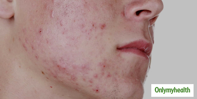Signs of PCOD and Acne