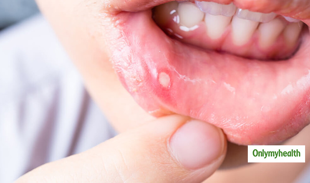 insidemouthulcer