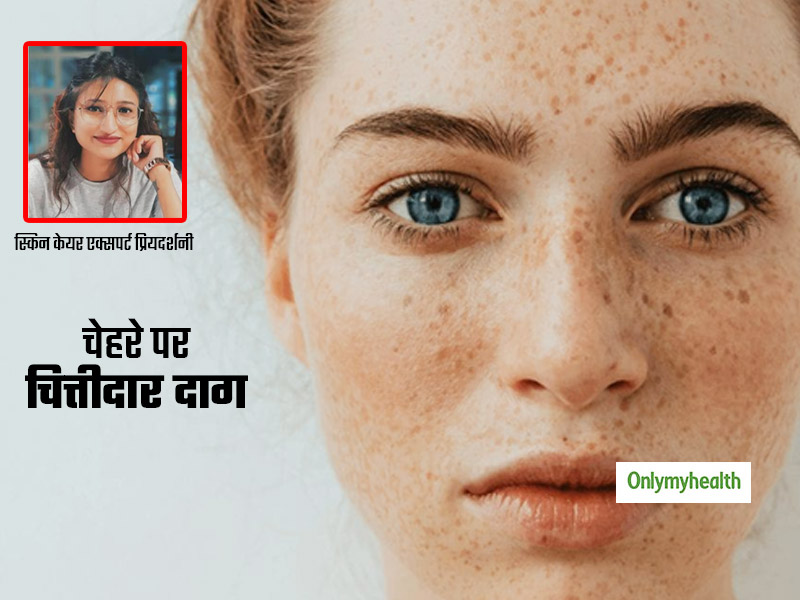 चेहरे पर चित्तीदार दाग (Freckles) खराब कर सकती है आपकी खूबसूरती, एक्सपर्ट से जानें इसे कम करने के 5 उपाय