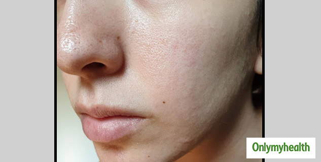 skin pores or open pores
