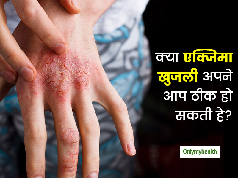 क्या खुजली वाला चर्म रोग 'एक्जिमा' अपने आप ठीक हो सकता है? जानें इसे फैलने से कैसे रोकें