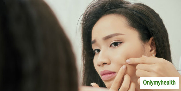 Garlic For Treat Acne