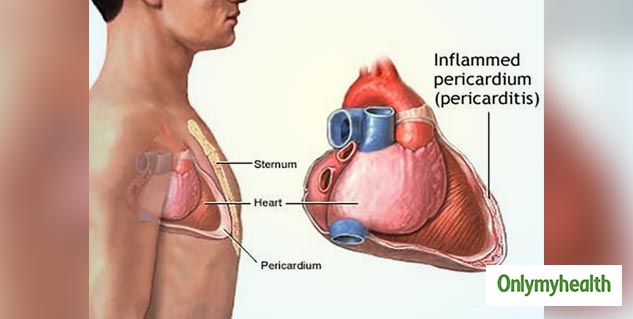 inside_periciaditis