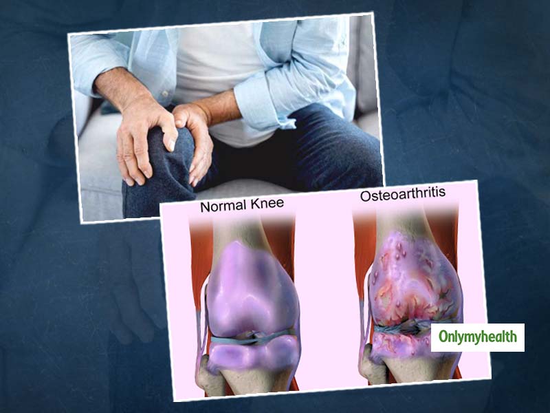 Early Arthritis का संकेत है हड्डियों से आवाज आना, विशेषज्ञ से जानें ऑस्टियोअर्थराइटिस से जुड़ी सभी बातें