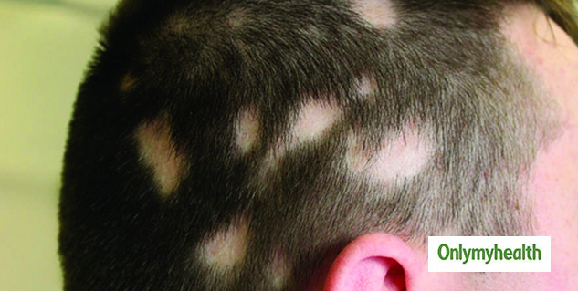 hair patch treatment