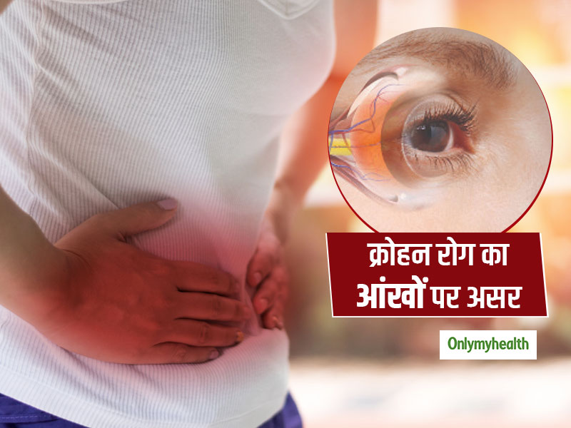 Crohn’s Disease: पेट सी जुड़ी इस बीमारी का आंखों पर भी होता है असर, जानें इसके लक्षण और बचने के उपाय