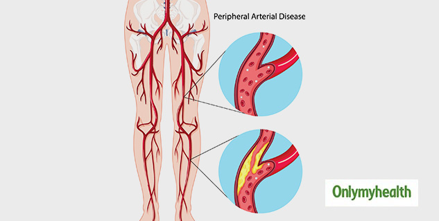 inside_Peripheral Artery Disease