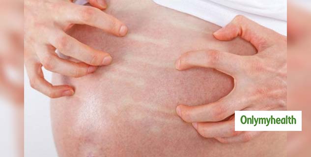 Cholestasis Sign in Pregnant Women