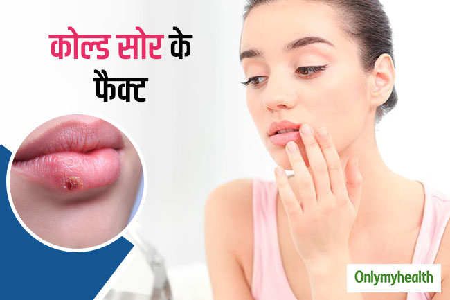 कोल्ड सोर से जुड़ी जानकारी