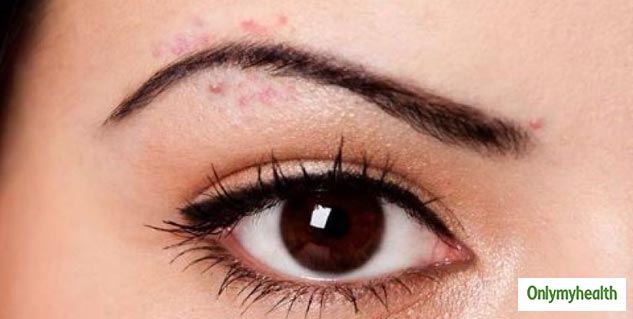 insideeyebrowpimples