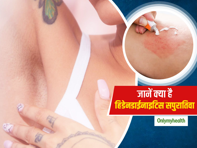 त्वचा पर दिखने वाले इस तरह के लक्षण हो सकते हैं Hidradenitis suppurativa का संकेत, जानें क्या है वजह