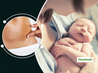 Here Are 5 Myths About Cesarean Delivery 