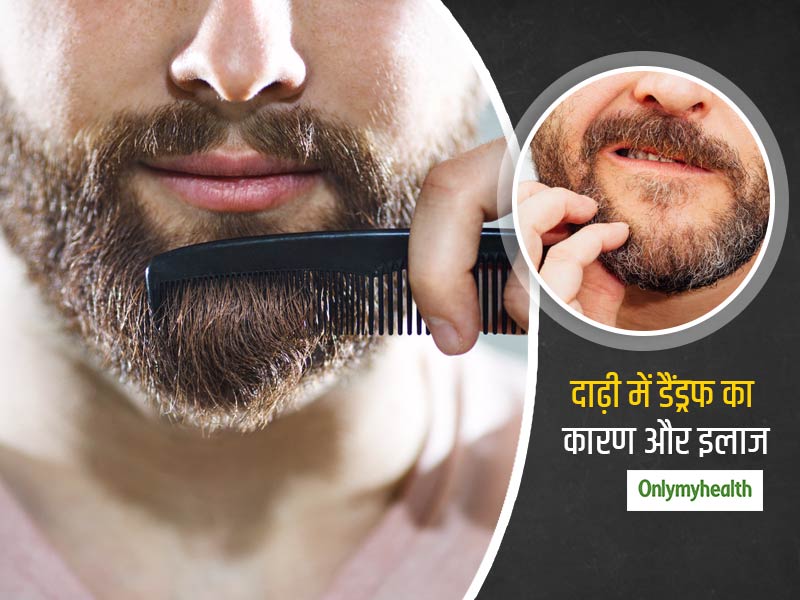 दाढ़ी में रूसी से छुटकारा पाना है तो रोज करे ये 3 काम, न होगा बियर्ड डैंड्रफ का डर और न कटवानी पड़ेगी दाढ़ी