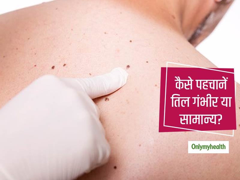 शरीर में दिखने वाले तिल सामान्य या त्वचा के कैंसर का संकेत? जानें कैसे करें इसकी सही पहचान