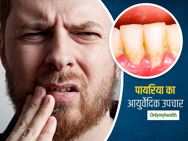 पायरिया के लक्षण हैं मसूड़ों में सूजन, खून आना और मुंह की दुर्गंध- जानिए इसके आयुर्वेदिक उपचार