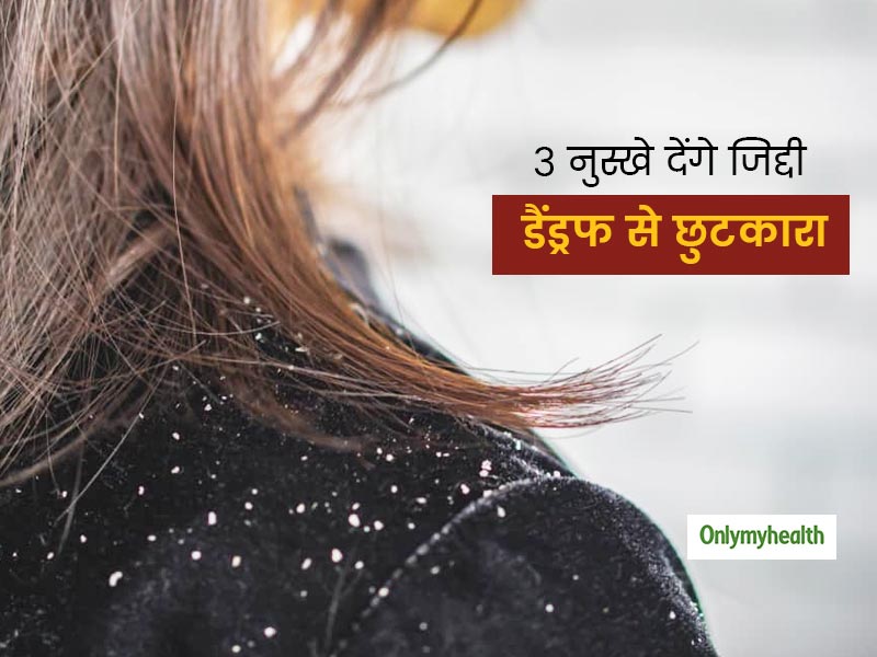 महंगे से महंगा शैम्पू करने पर भी बालों से नहीं जा रहा जिद्दी डैंड्रफ! 3 नुस्खे देंगे दर्जनभर समस्याओं से निजात