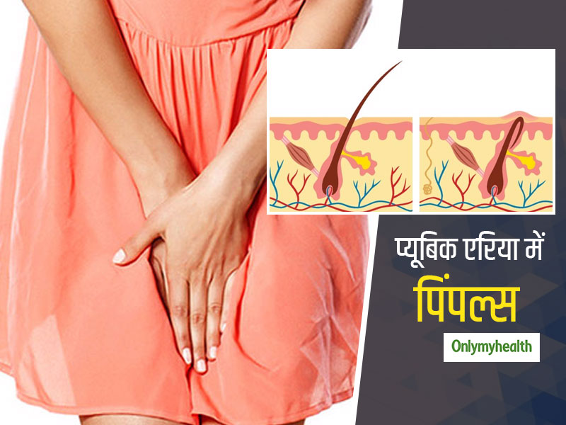 Women's Health: प्यूबिक एरिया में क्यों होते हैं ऐक्ने और पिंपल्स? जानें वैजाइनल पिंपल्स से बचने के उपाय