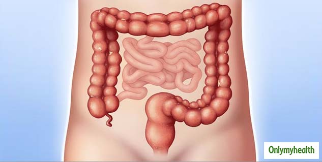 ulcer colitis