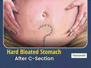 How To Get Rid Of Swollen Abdominal Muscles After C-Section?