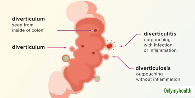 insidecausesofdiverticulitis