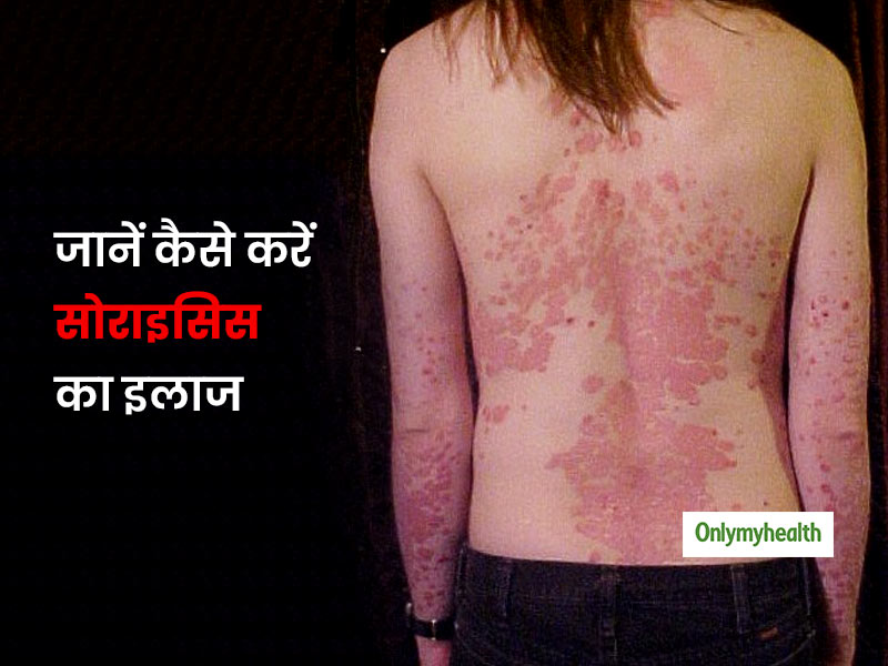 त्वचा में दरार और खून बहना हो सकता है 'सोराइसिस' रोग का संकेत, जानें इस स्थिति में हल्दी कैसे है फायदेमंद