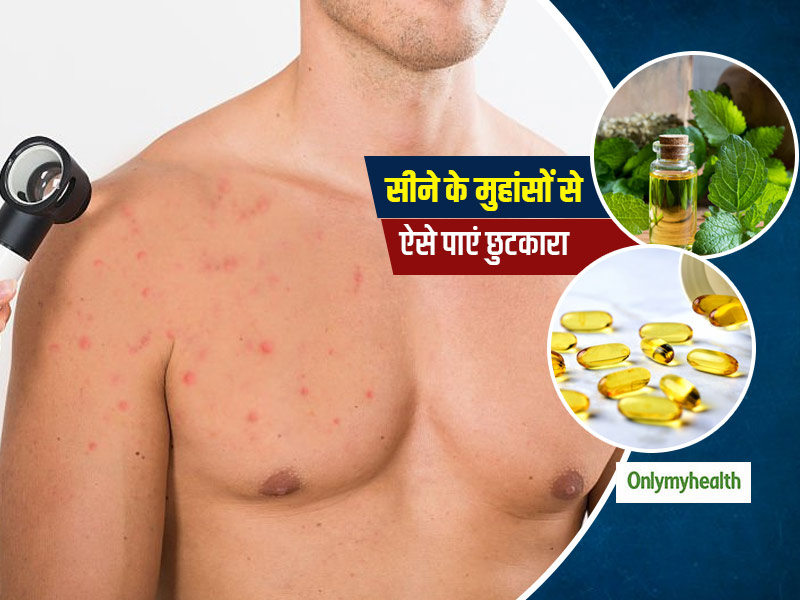 कई कारणों से पुरुषों को होते हैं Chest Acne, जानें छाती में होने वाले इस एक्ने को कम करने का तरीका