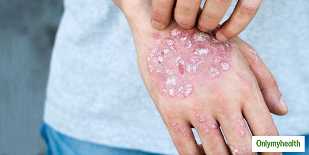 insidePsoriasis