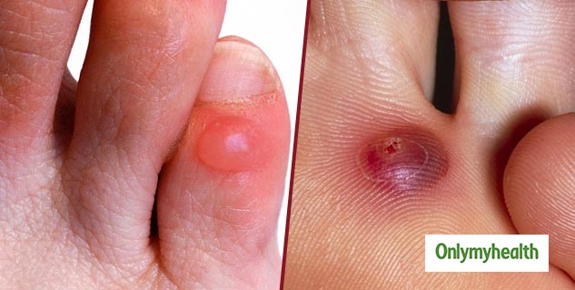 foot blister