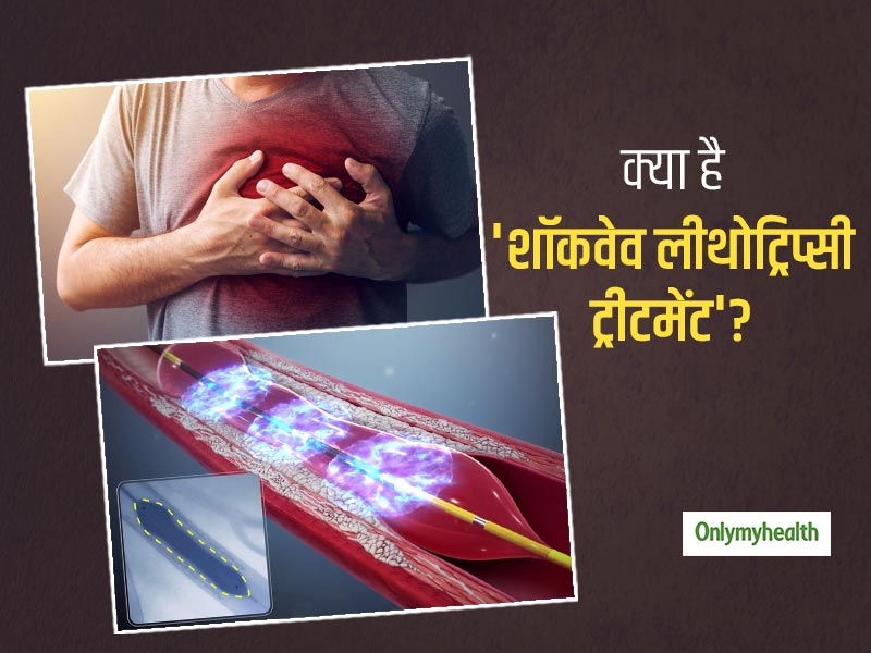 आर्टरी में ब्लॉकेज की समस्या को दूर कर सकता है 'शॉकवेव लीथोट्रिप्सी ट्रीटमेंट', जानें क्या है ये और इसके फायदे