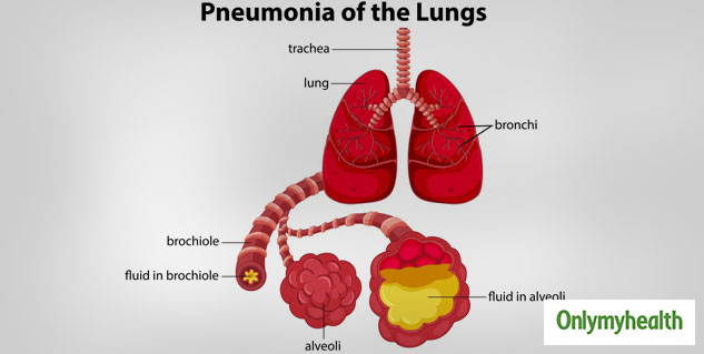pneumonia