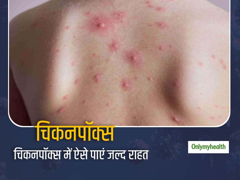 जानें क्या है चिकनपॉक्स के प्रमुख लक्षण और इलाज के आसान तरीके