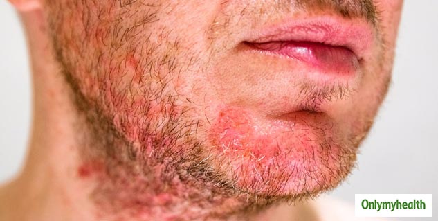Seborrheic Eczema