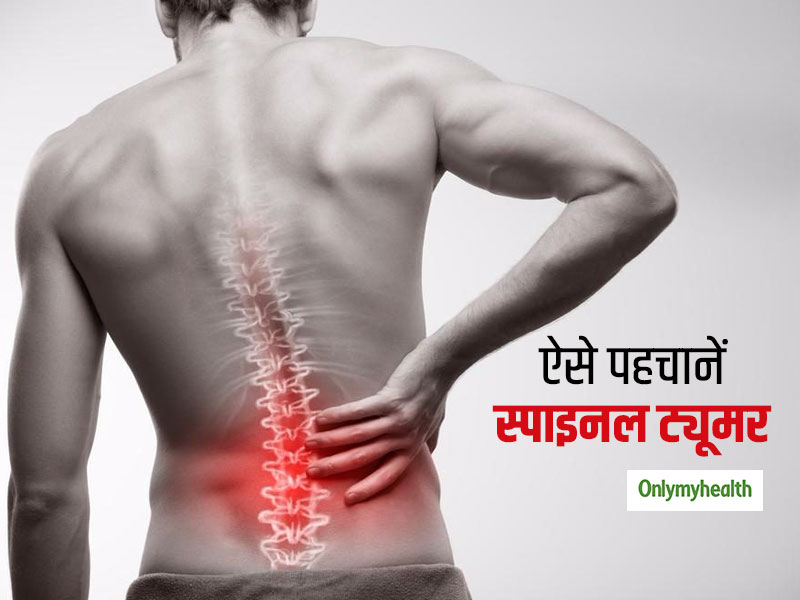 स्पाइनल ट्यूमर रोग के कारण भी हो सकता है लगातार कमर दर्द, इन तरीकों से करें इसकी पहचान