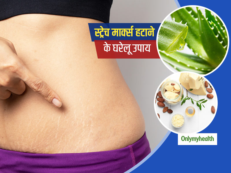 स्ट्रेच मार्क्स प्रेग्नेंसी का हो या मोटापे का, इससे छुटकारा पाने के लिए इस्तेमाल करें ये 5 घरेलू नुस्खे