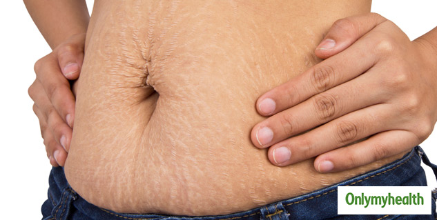 insidetipsforstrechmarks