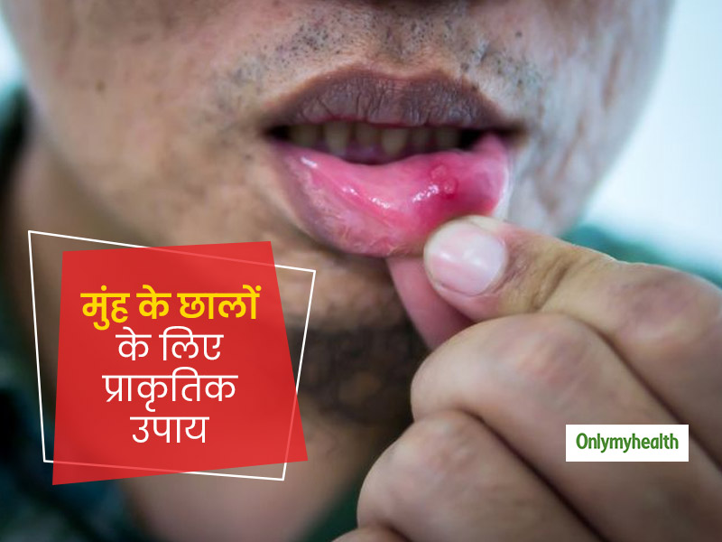 गर्मियों में मुंह के छालों से हैं परेशान? इन 5 घरेलू नुस्खों से पाएं तुरंत राहत और दूर करें दर्द और जलन
