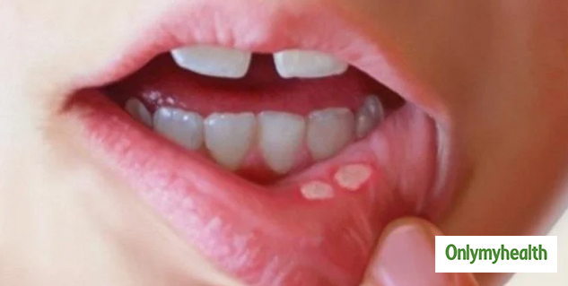 mouthulcer
