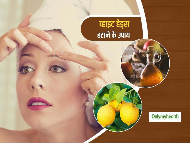ब्लैकहेड्स के मुकाबले ज्यादा जिद्दी होते हैं व्हाइट हेड्स, जानें चेहरे से व्हाइट हेड्स हटाने के उपाय