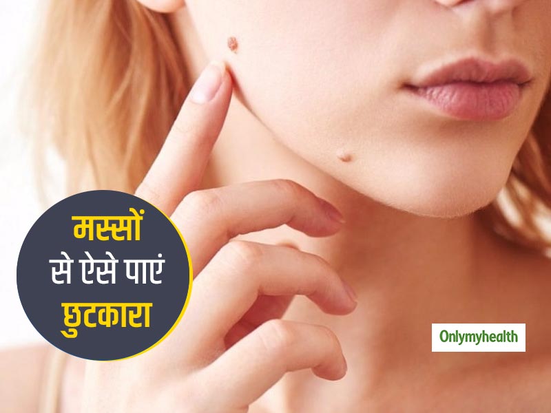 शरीर पर आए अनचाहे मस्सों से आप भी हैं परेशान, तो इन घरेलू तरीकों से पाएं जल्द छुटकारा