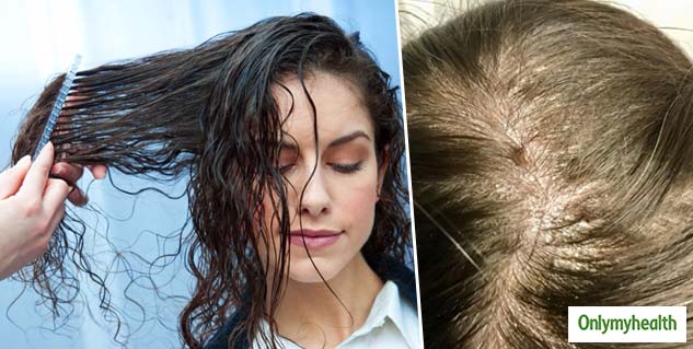 insidehomeremediesScalpPsoriasis