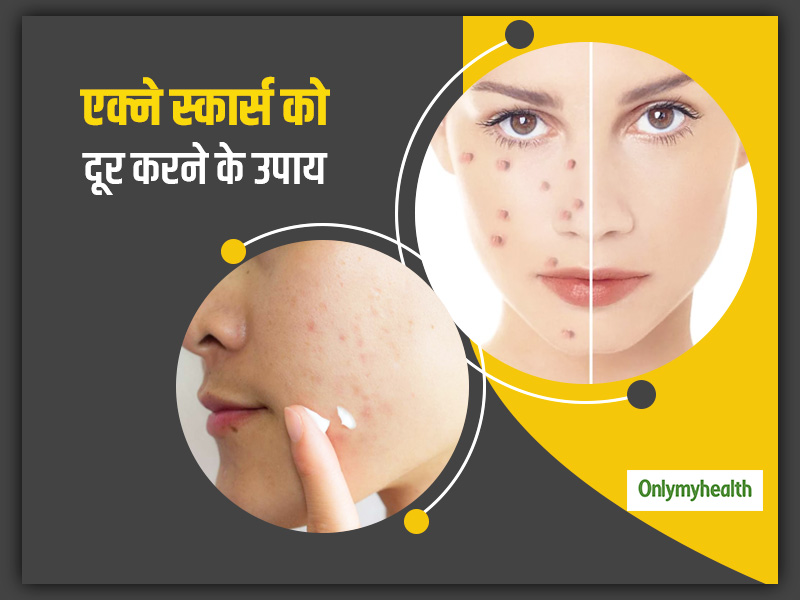 एक्ने स्कार्स से न बिगड़ जाए आपकी खूबसूरती, इसके लिए आजमाएं ये 5 प्राकृतिक उपाय