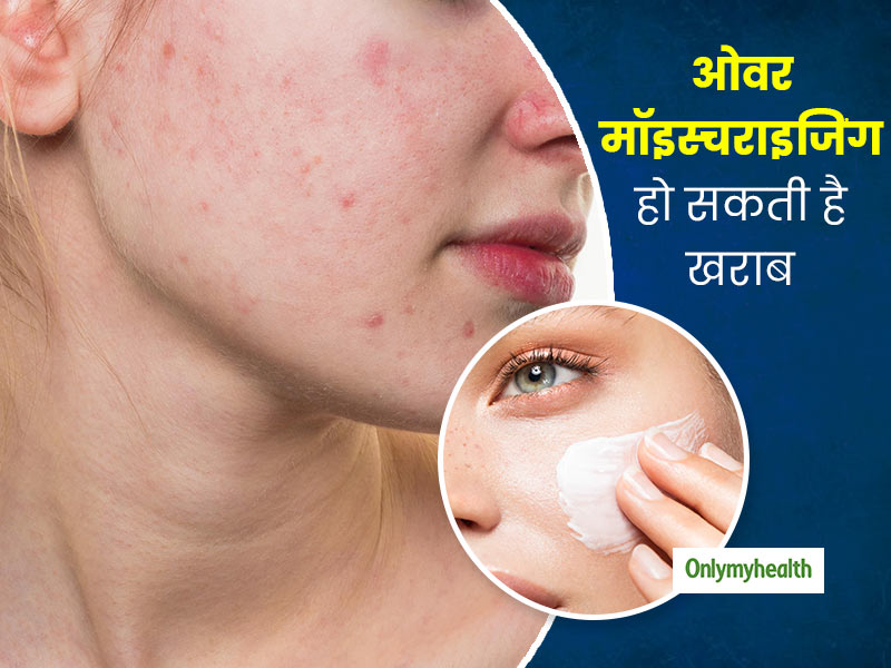 स्किन को ओवर-मॉइस्चराइज करना बन सकता है पिंपल्स की वजह, जानें कब और कितनी मॉइस्चराइजिंग है सही
