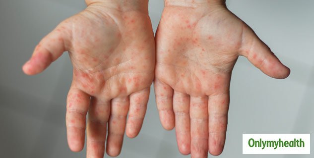 insideMeaslesinchildrens