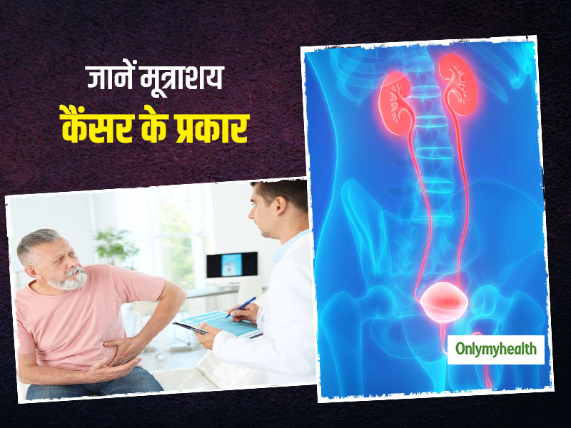 कितने प्रकार के होते हैं मूत्राशय कैंसर (Bladder Cancers) ? जानें किन लोगों को होता है इसका ज्यादा खतरा