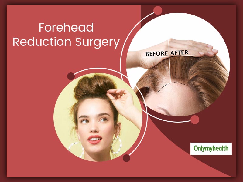 What Is Forehead Reduction Surgery? Know Everything About Its Risks And Side-Effects